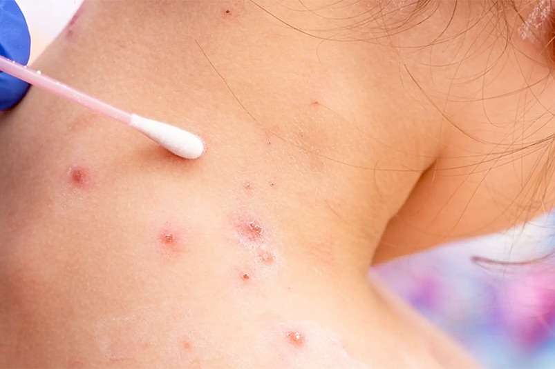 detección viruela del mono