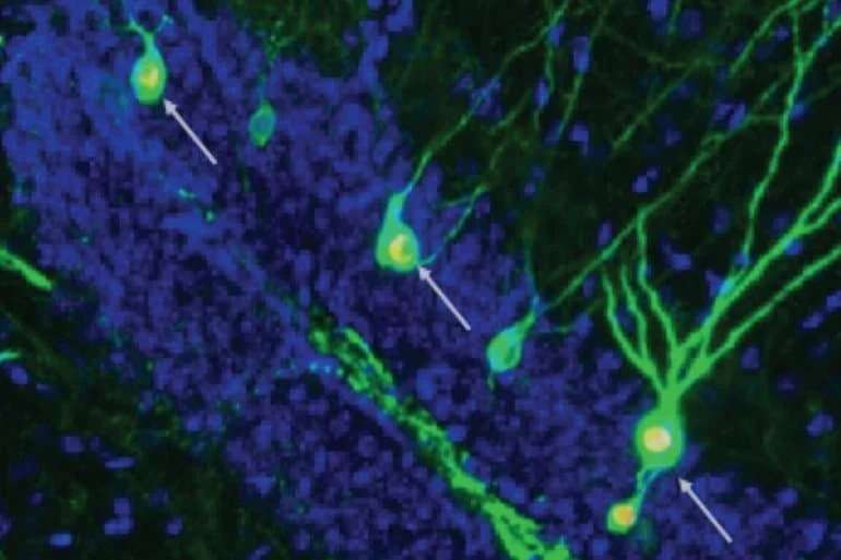 neuronas alzheimer 02