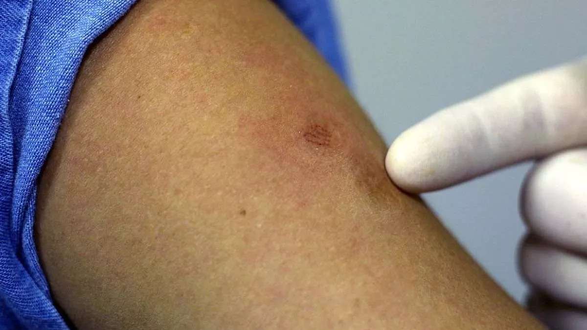 Salud descarta restricciones por contagios de viruela del mono