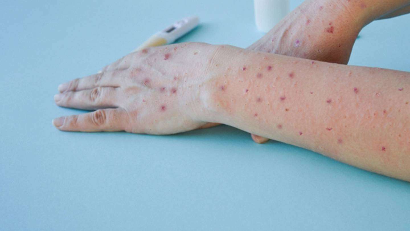 Salud confirma dos casos más de viruela del mono, suman cinco activos