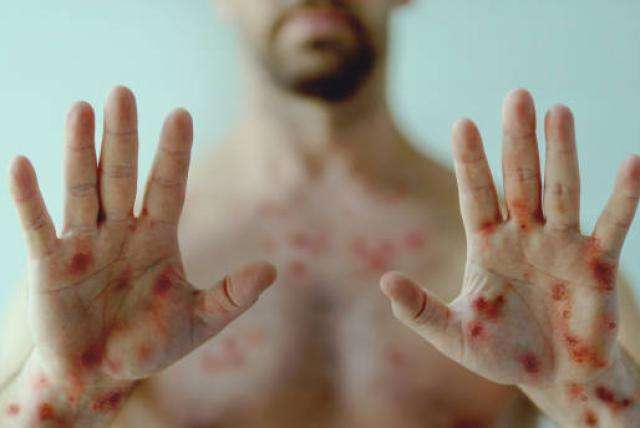 10 casos más de viruela del mono en Guatemala