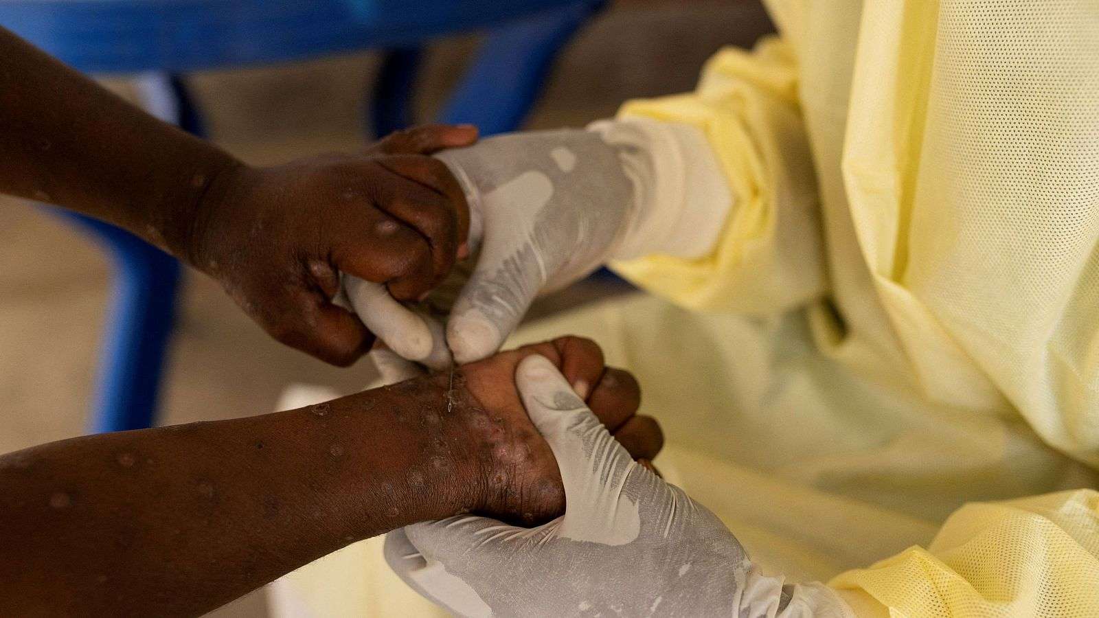 Registrados casi 19.000 casos de mpox y 540 muertes en doce países de África en 2024