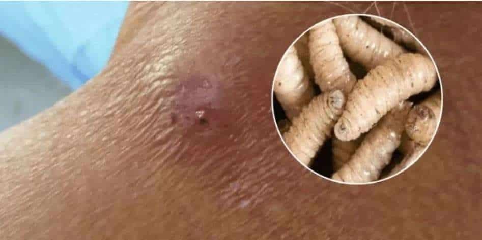 ¿Puede el gusano barrenador afectar a las personas?