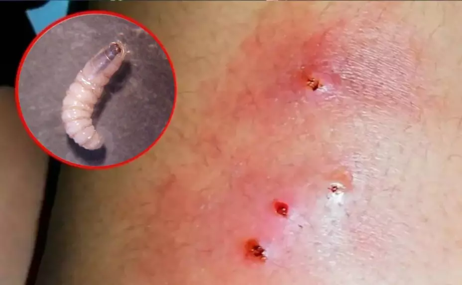 ¿Gusano barrenador en humanos? Autoridades reportan nuevos diagnósticos