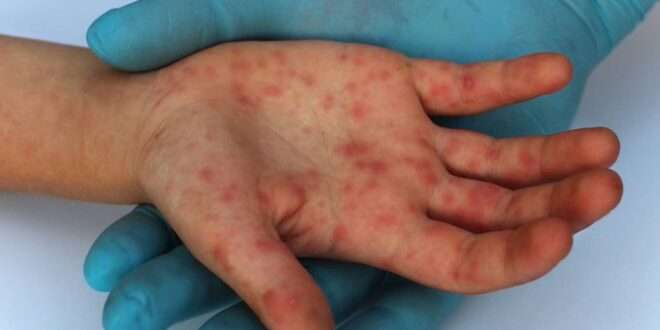 IGSS reactiva alerta sanitaria: ¿Está Guatemala preparada para la viruela símica?