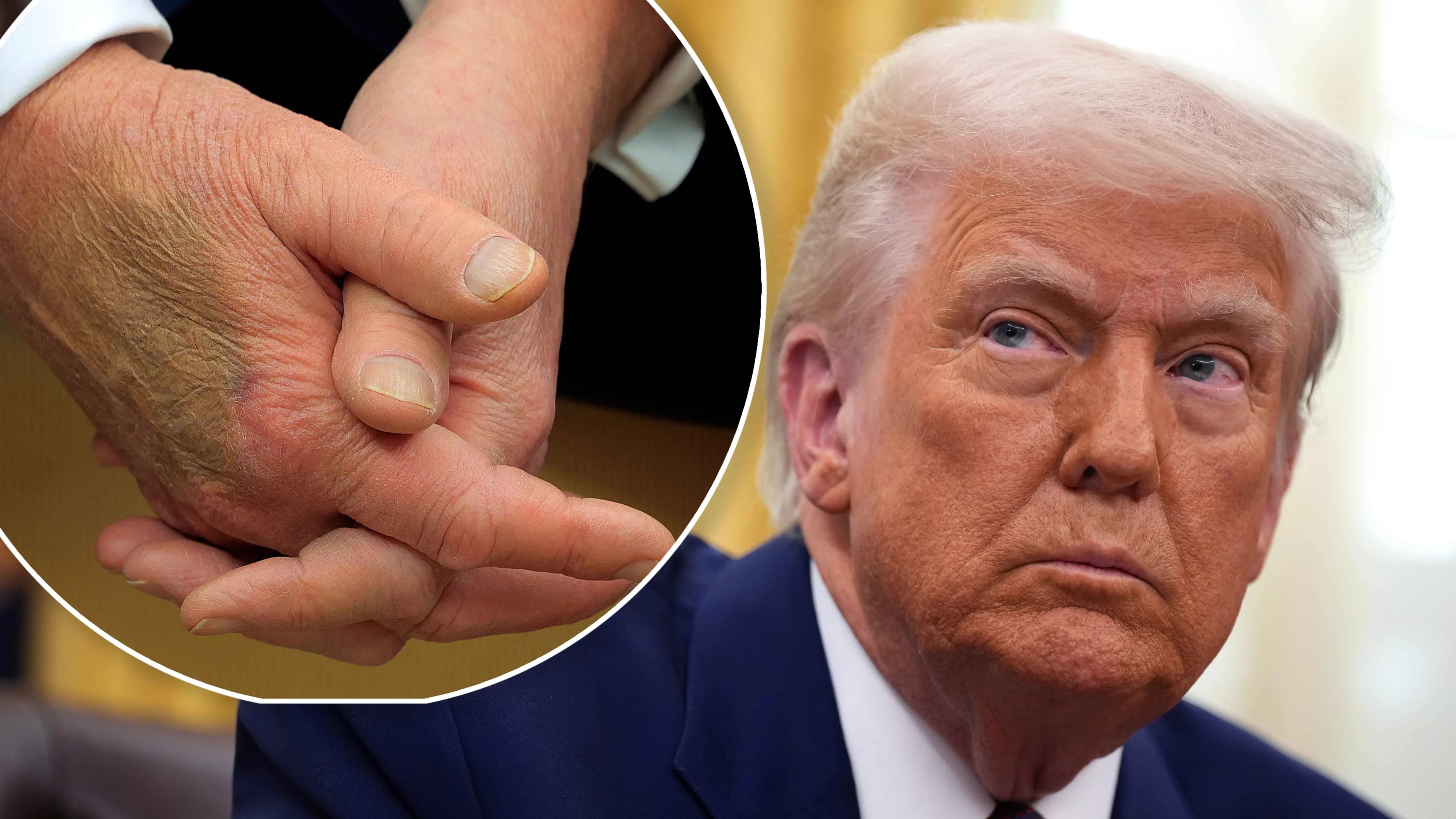 Moretones, hinchazón y estudios vasculares ¿Qué pasa con la salud de Trump?